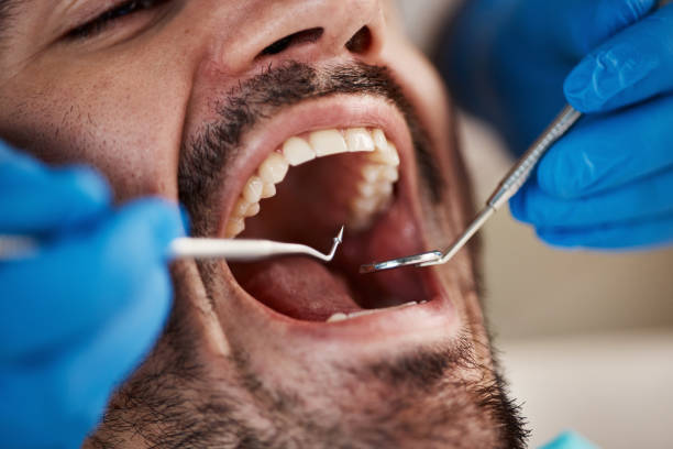 Best Dentist for Tooth Abscess  in Sanborn, IA